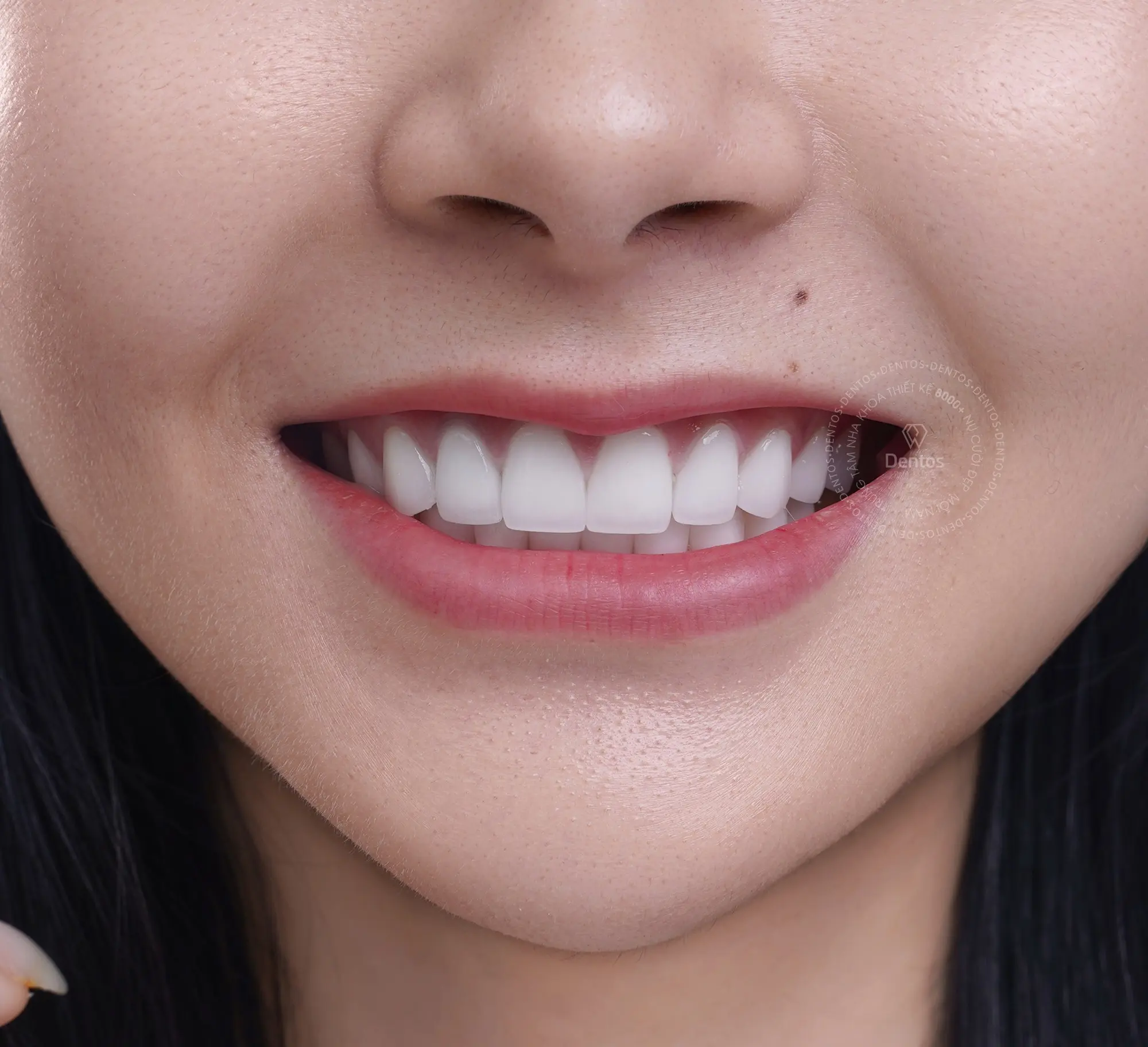 Vật liệu sứ chính hãng tương thích sinh học cao giúp răng sứ bền đẹp